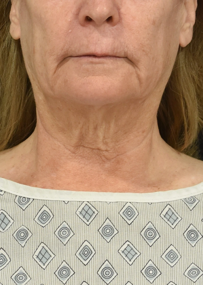 Neck Lift Patient 17 - Set 1 - Before